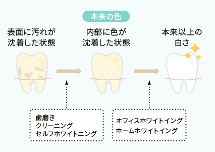 オフィルホワイトニング・ホームホワイトニング・ディユアルホワイトニング・セルフホワイトニング
